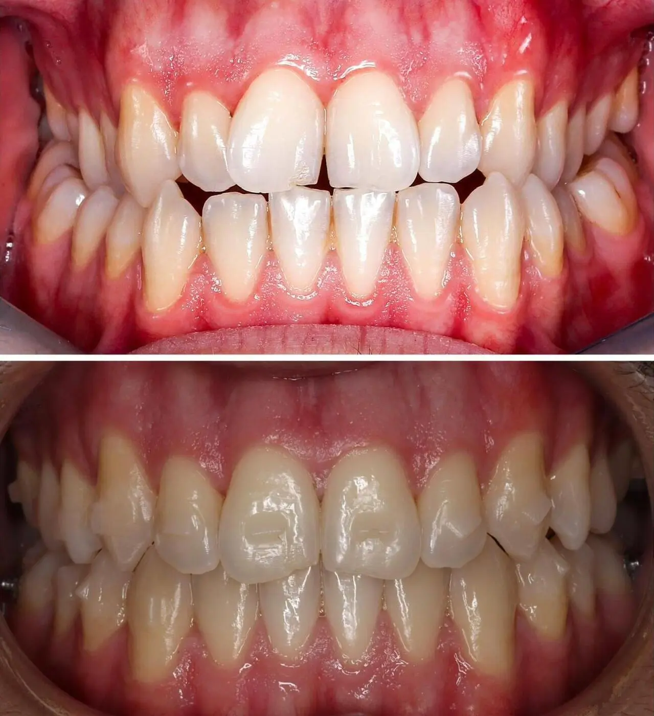 Before & after aparat dentar Cluj – caz 1 ProDent