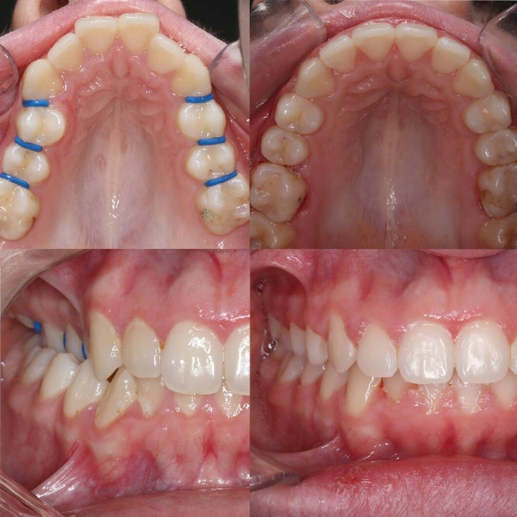 Before & after aparat dentar Cluj – caz 10 ProDent