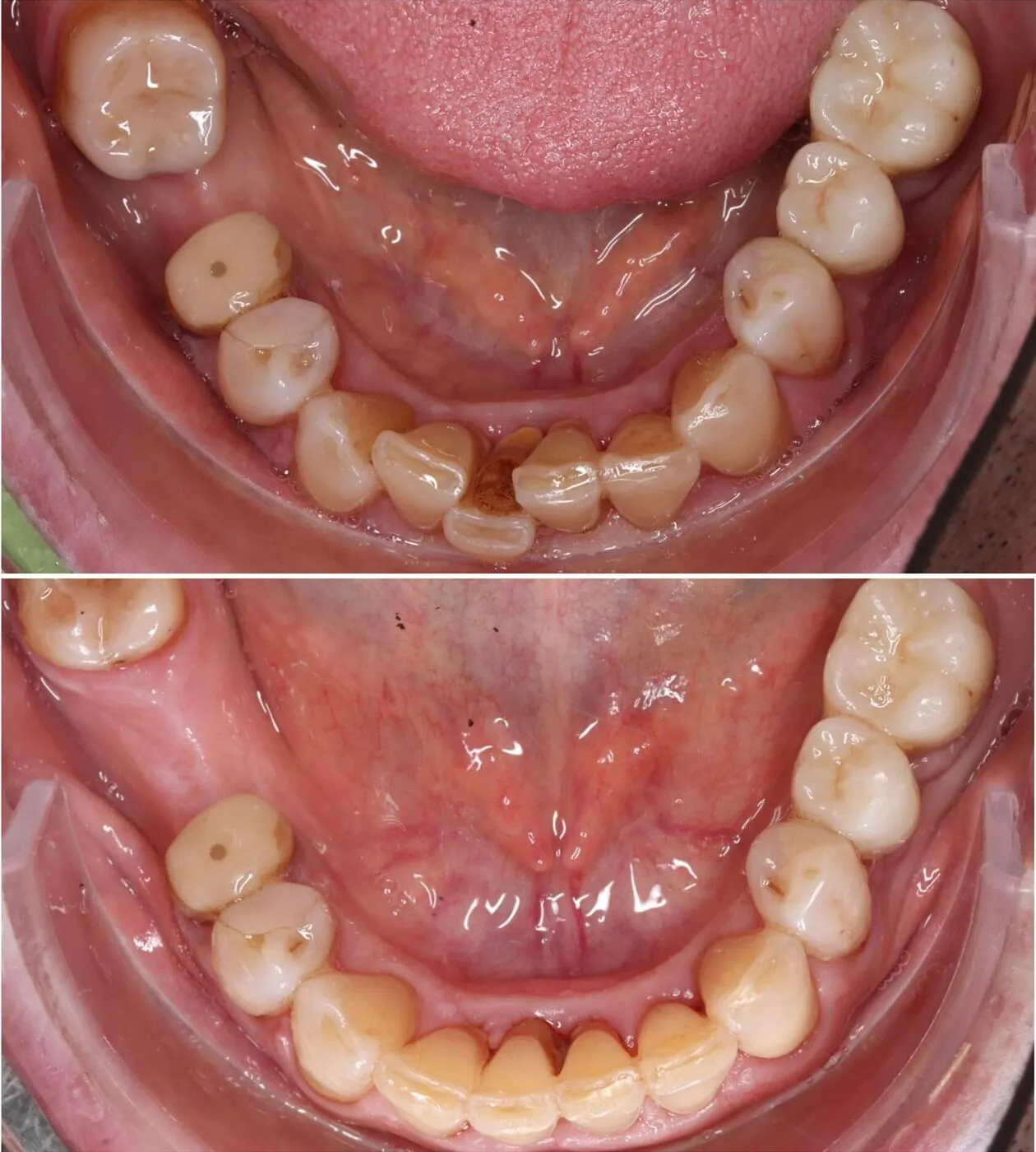 Before & after aparat dentar Cluj – caz 11 ProDent