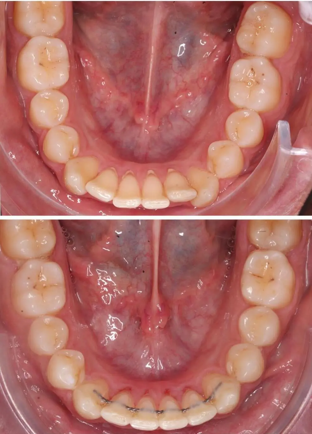 Before & after aparat dentar Cluj – caz 12 ProDent