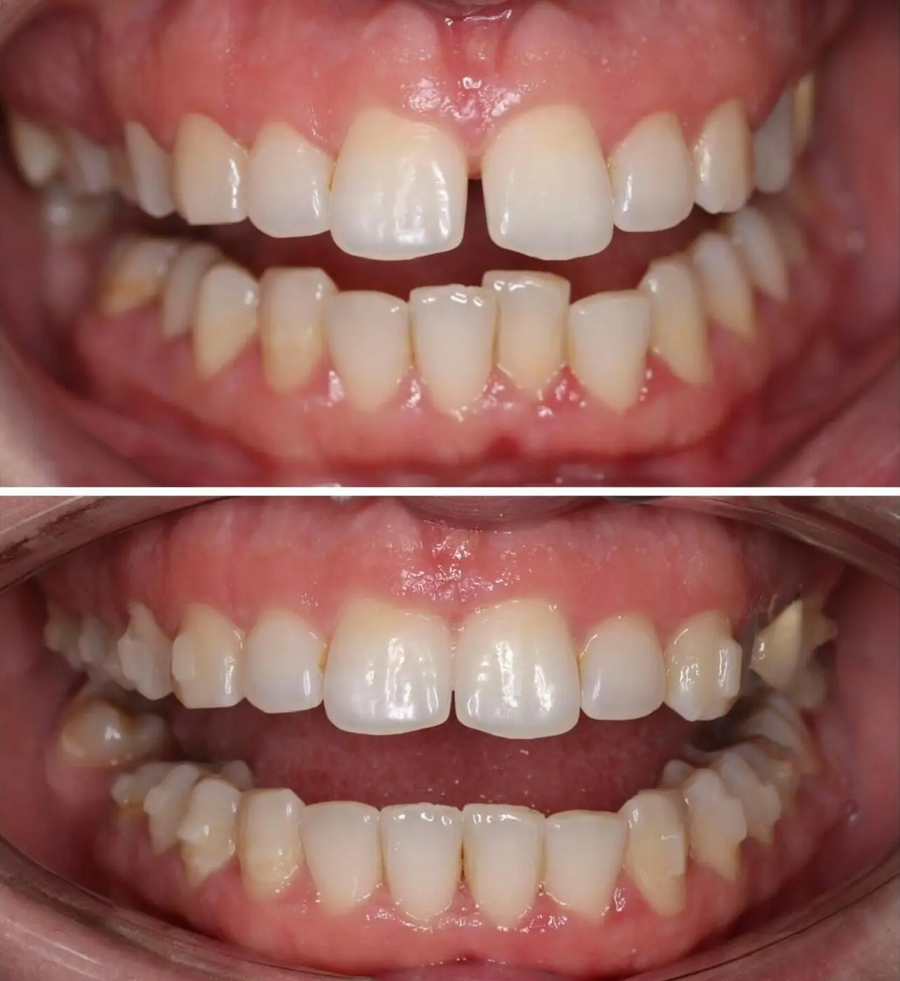 Before & after aparat dentar Cluj – caz 13 ProDent