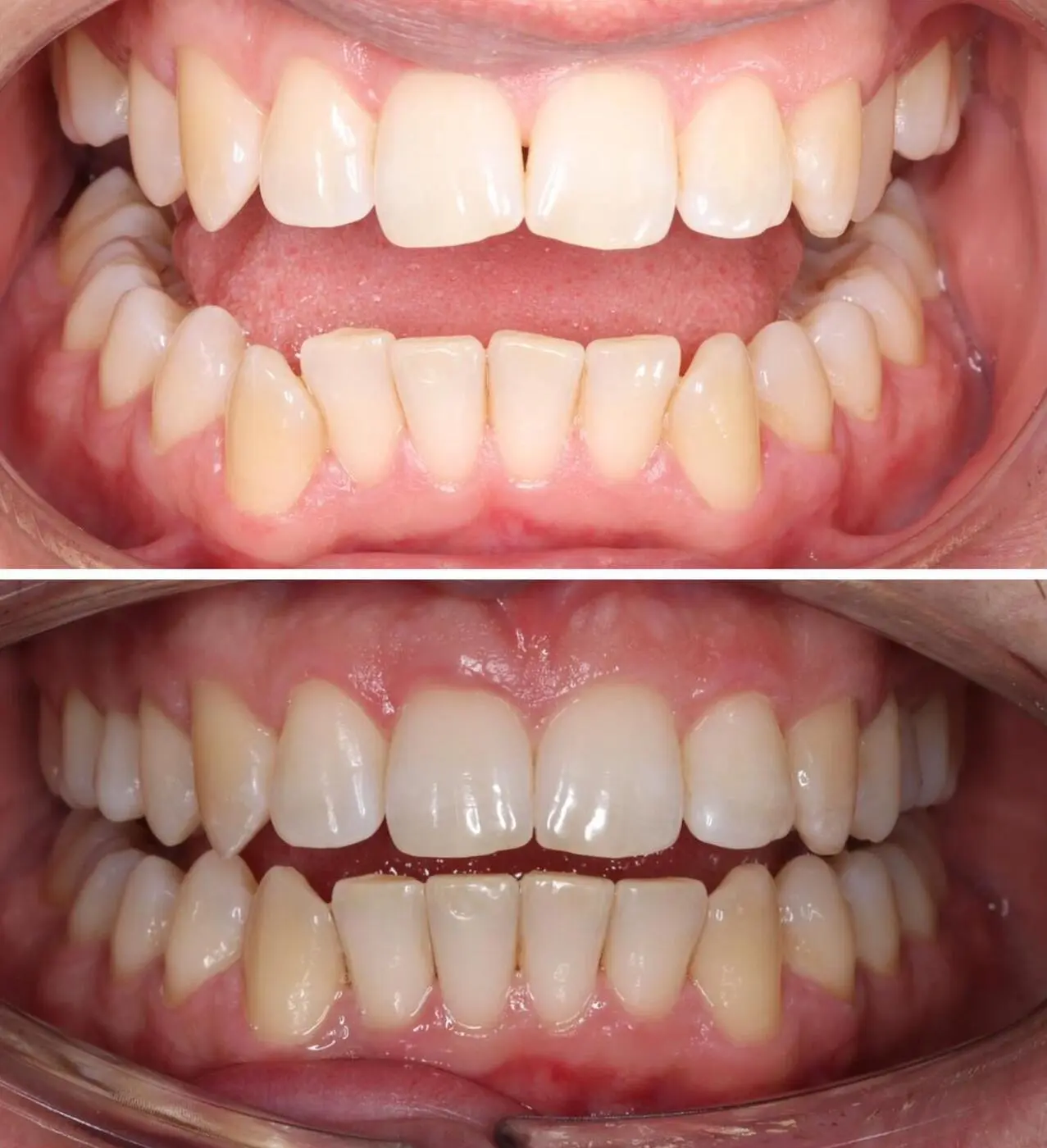 Before & after aparat dentar Cluj – caz 14 ProDent