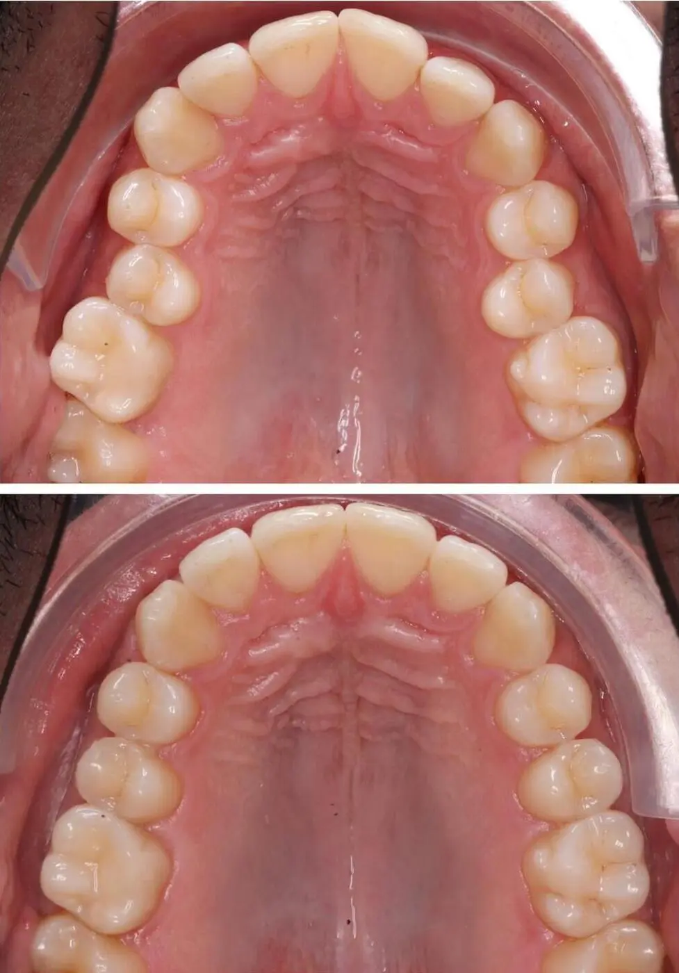 Before & after aparat dentar Cluj – caz 15 ProDent