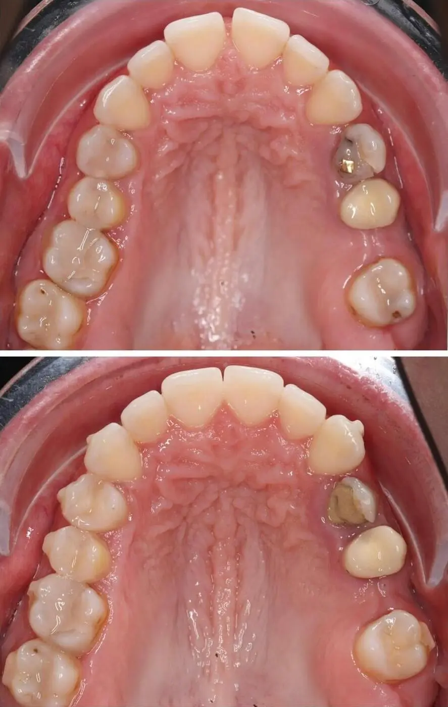 Before & after aparat dentar Cluj – caz 16 ProDent