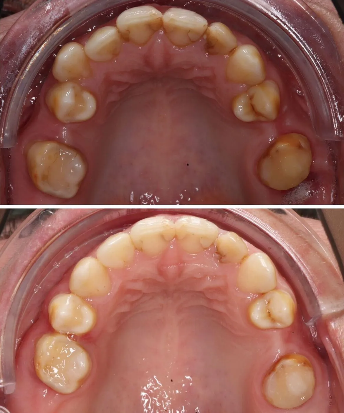 Before & after aparat dentar Cluj – caz 17 ProDent