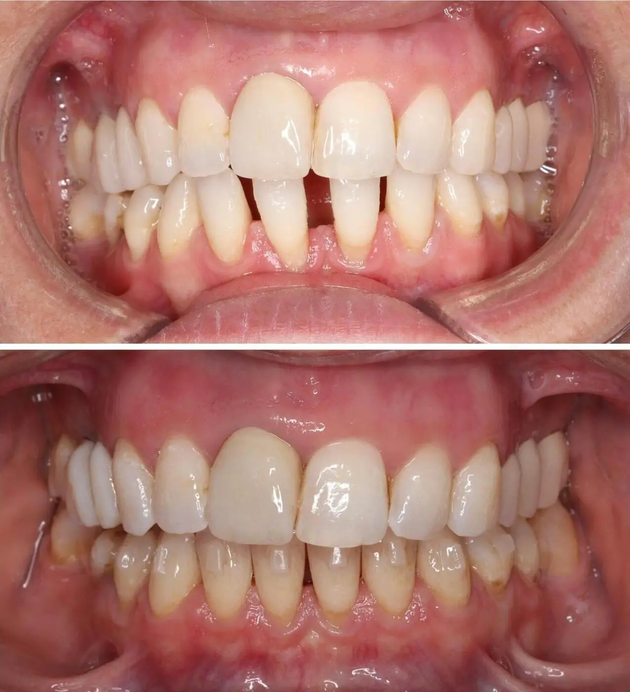 Before & after aparat dentar Cluj – caz 2 ProDent
