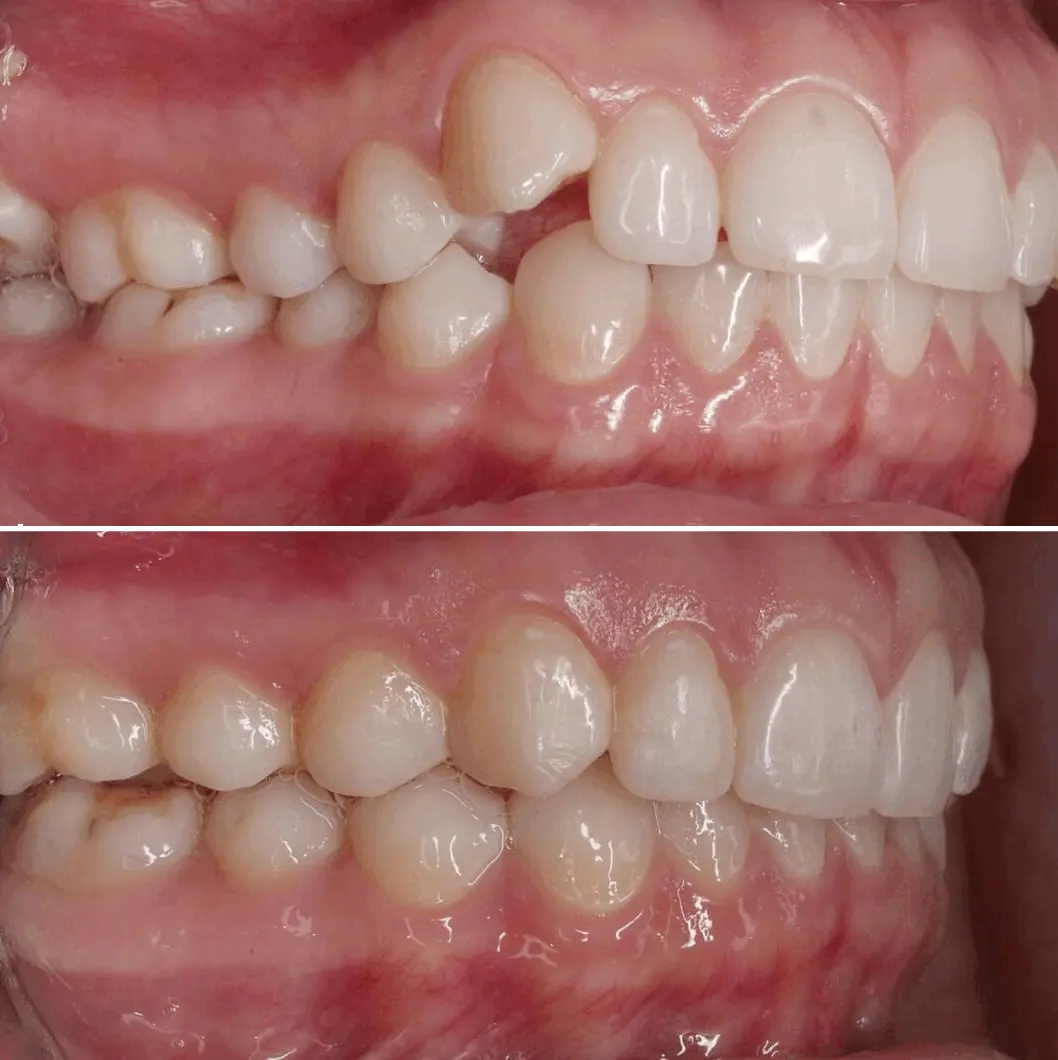 Before & after aparat dentar Cluj – caz 3 ProDent