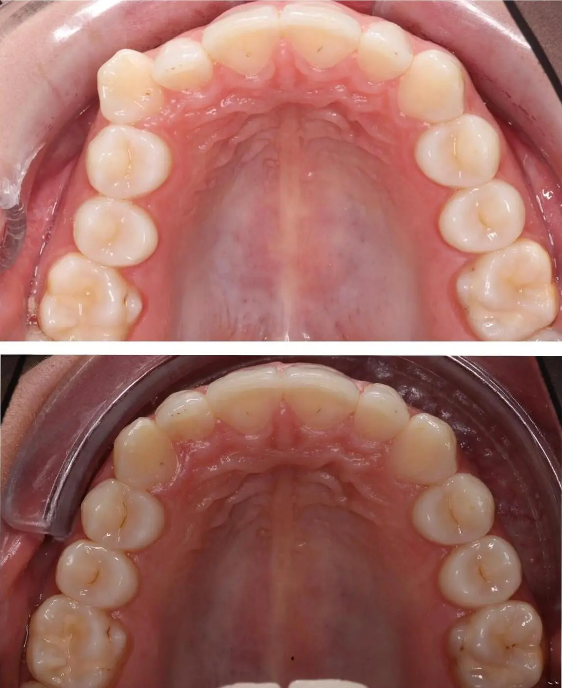 Before & after aparat dentar Cluj – caz 4 ProDent