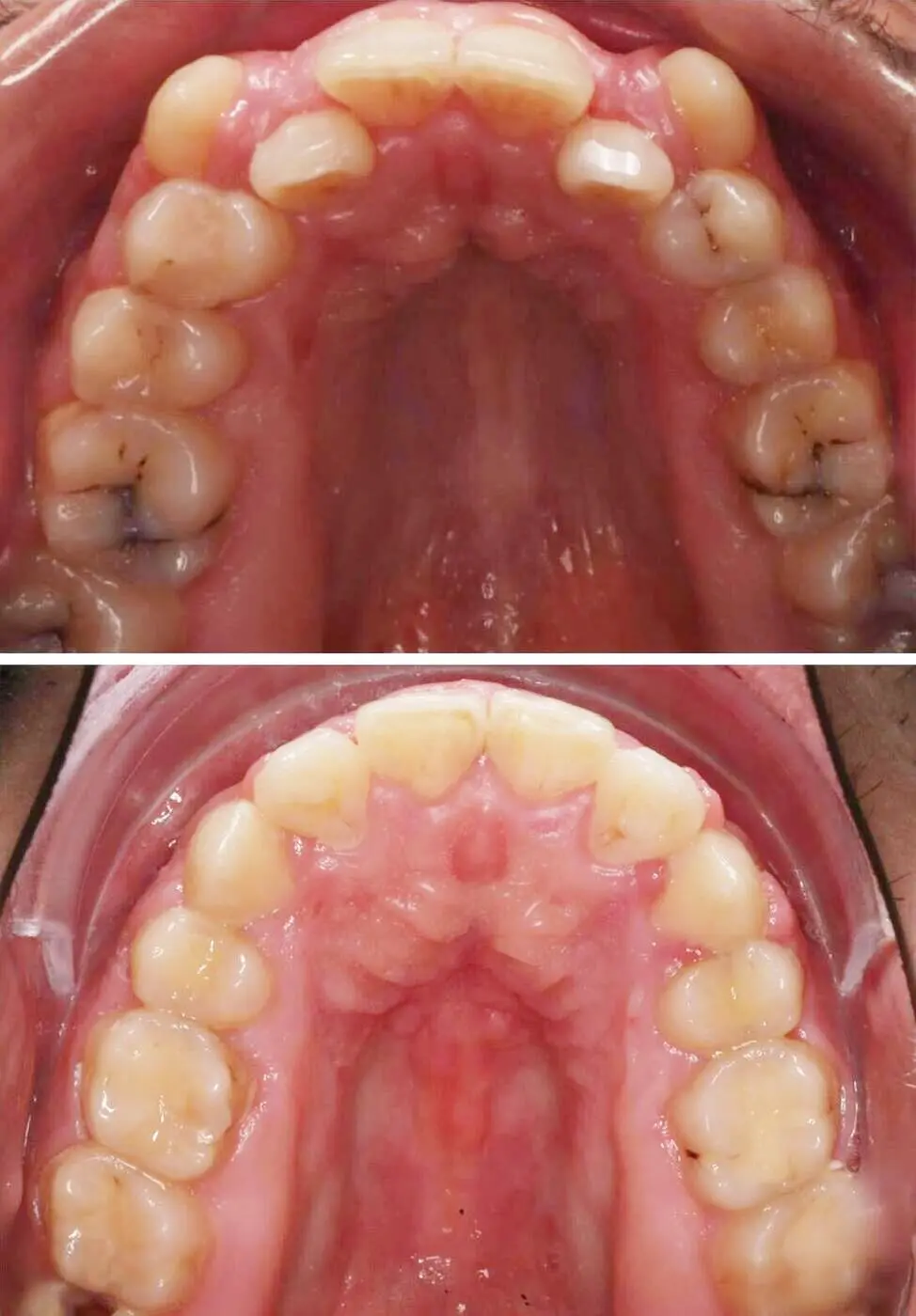 Before & after aparat dentar Cluj – caz 5 ProDent