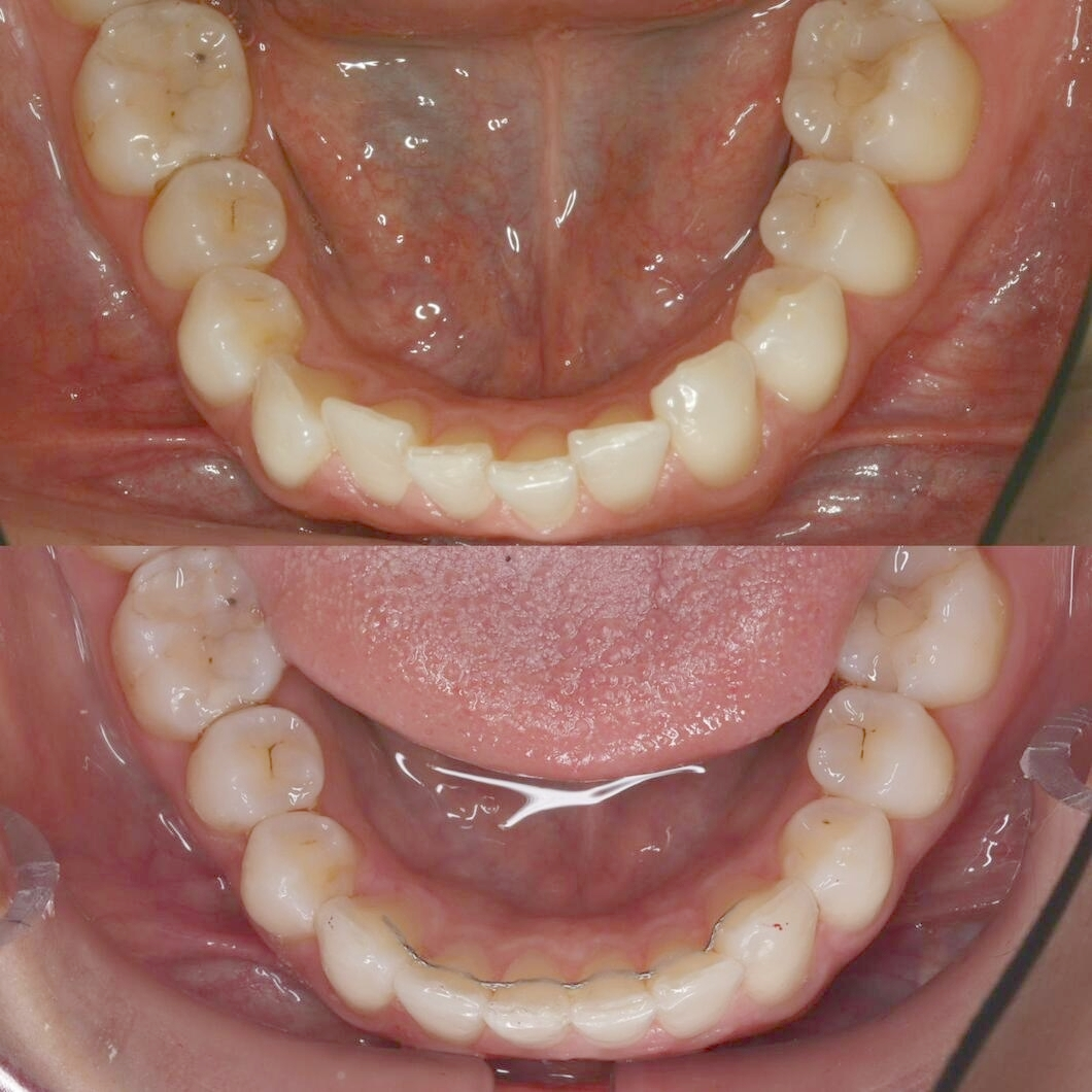 Before & after aparat dentar Cluj – caz 6 ProDent