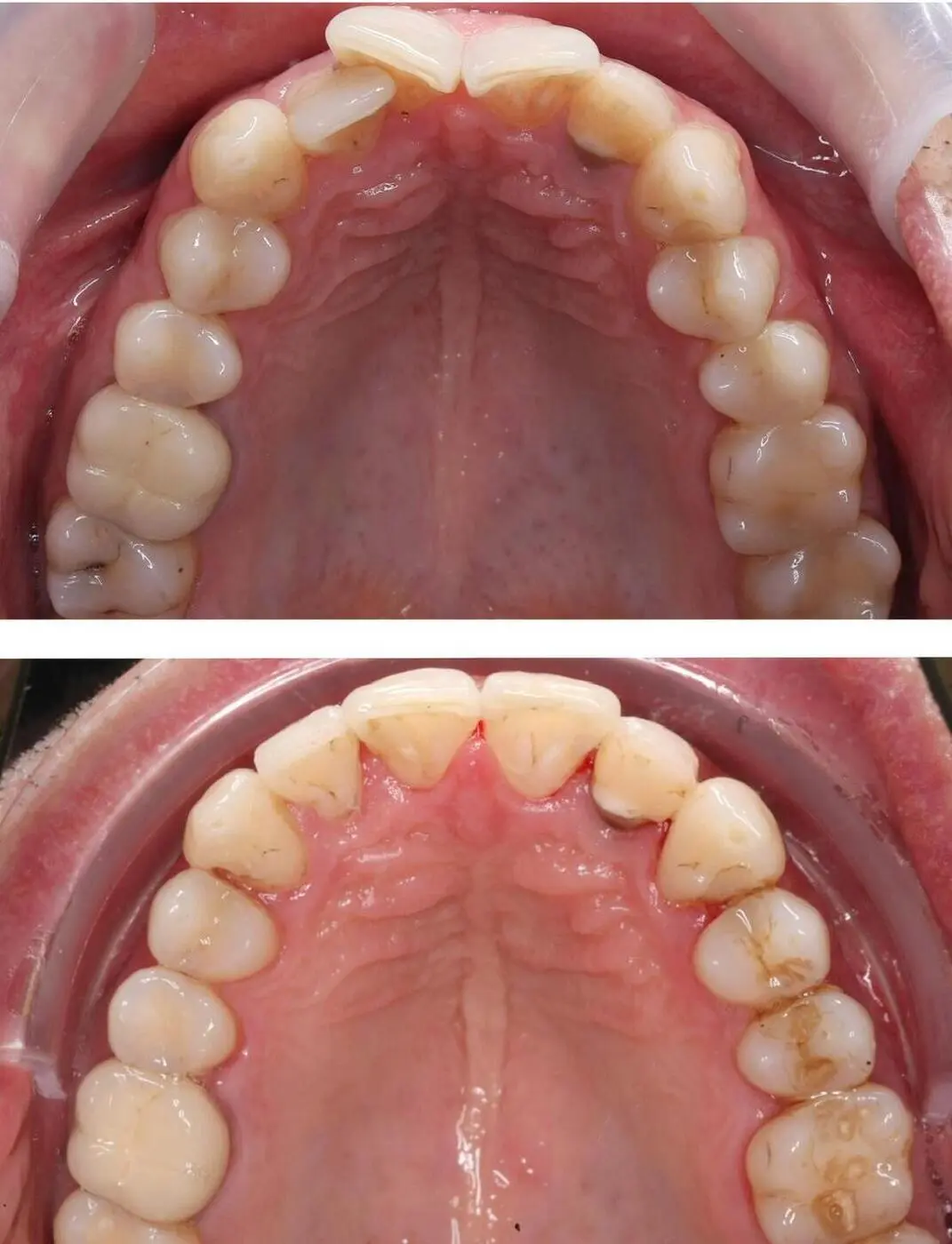 Before & after aparat dentar Cluj – caz 7 ProDent