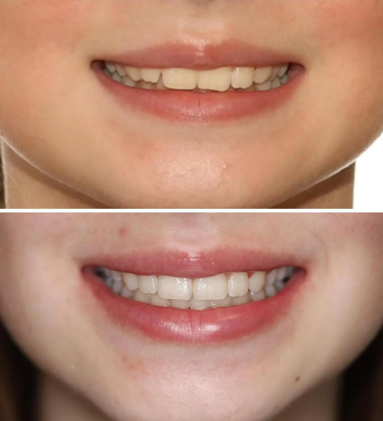 Before & after aparat dentar Cluj – caz 8 ProDent
