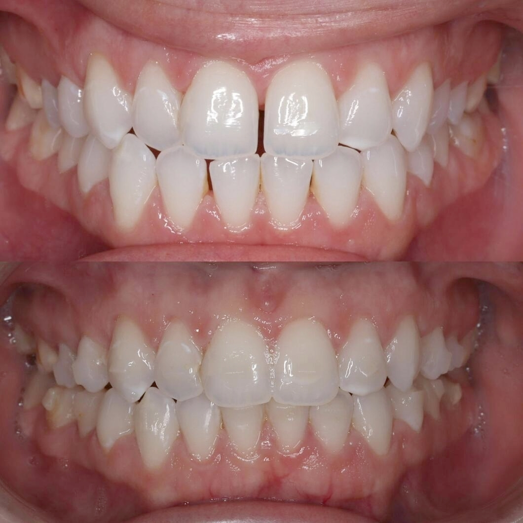 Before & after aparat dentar Cluj – caz 9 ProDent