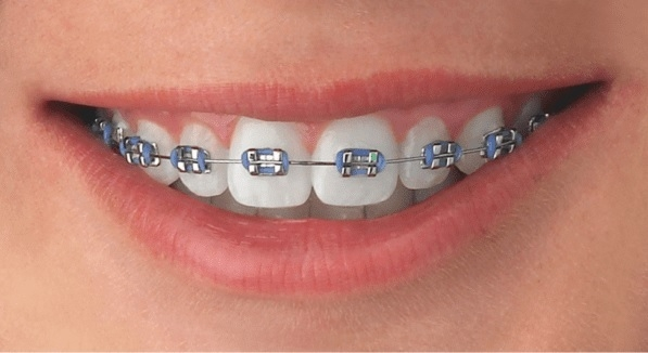 Aparat dentar metalic Cluj – brackeți metalici ProDent