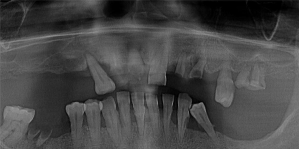 Caz 2: Dinti ficsi in 24 ore - Before Radiografie