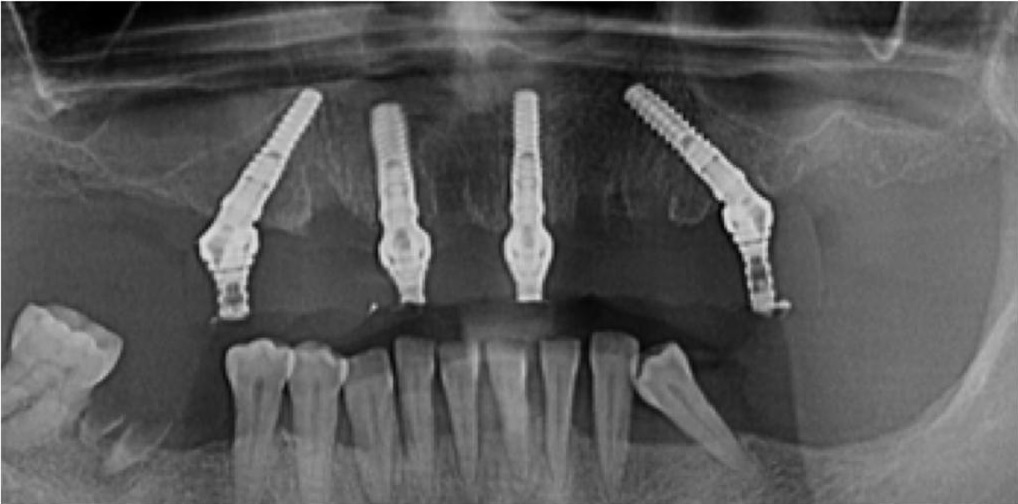 Caz 2: Dinti ficsi in 24 ore - After Radiografie