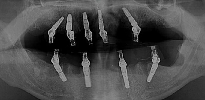 Caz 1: Dinti ficsi in 24 ore - After Radiografie