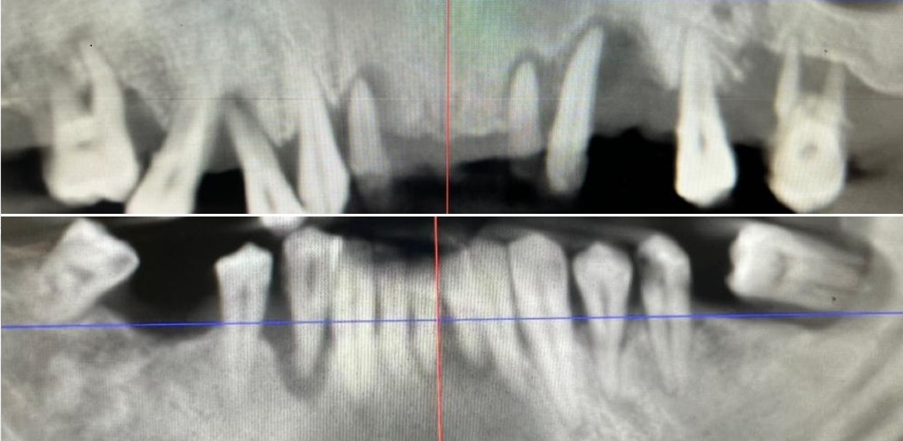 Caz 1: Dinti ficsi in 24 ore - Before Radiografie