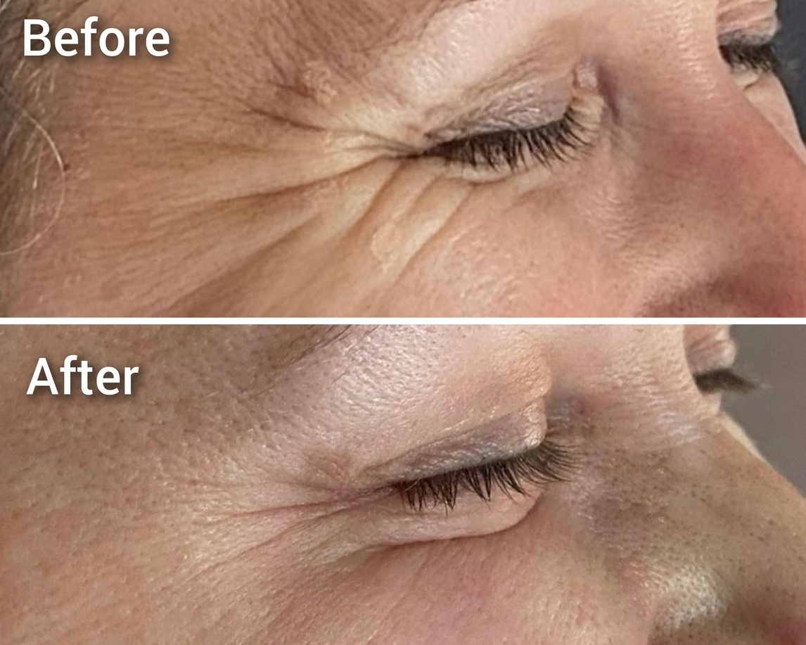botox cluj