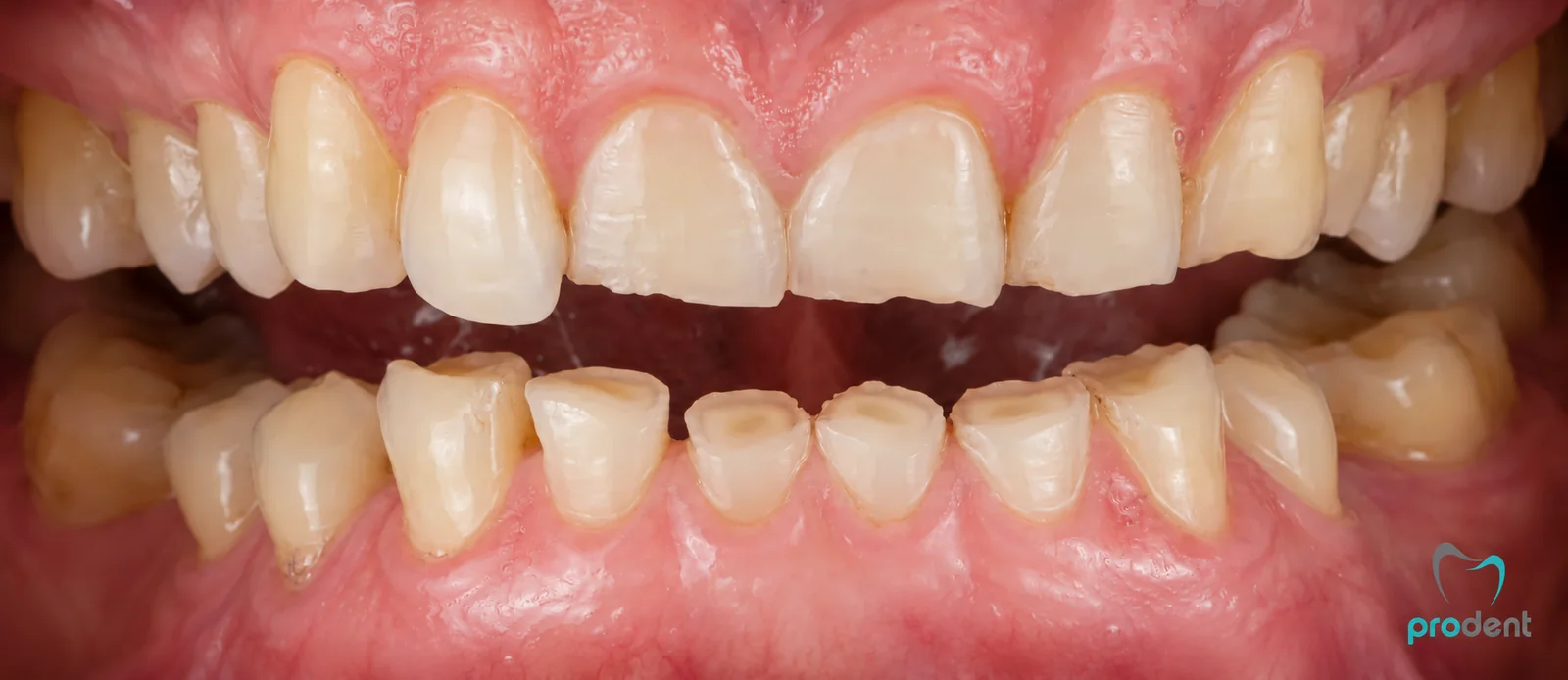 Dinți tociți, cu margini aplatizate și pierdere de țesut dentar
