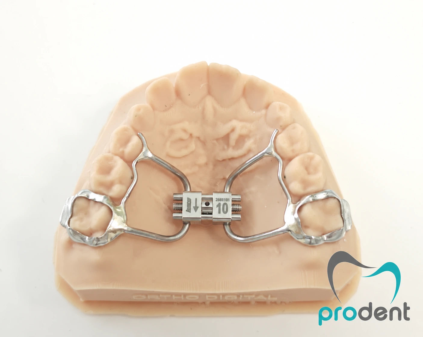 Disjunctor palatinal montat pe un model al arcadei dentare superioare