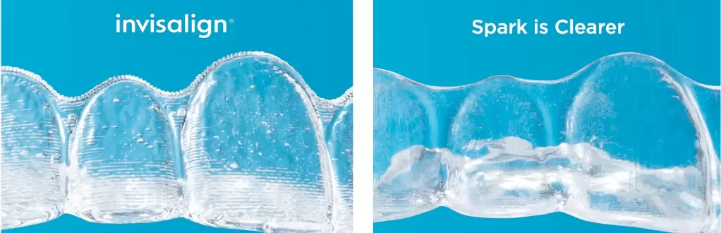 aparat ortodontic invizibil spark vs invisalign cluj prodent