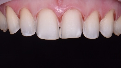 fatete dentare