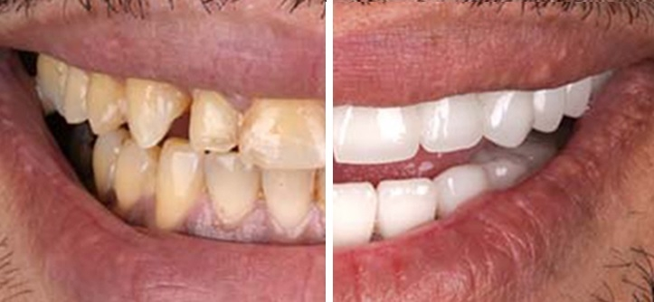 fatete dentare, fatete dentare cluj, fatete dinti, hollywood smile