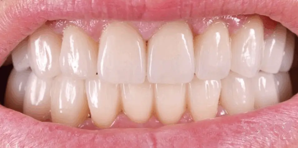 After – coroane dentare aplicate peste dinți tratați endodontic la ProDent Cluj