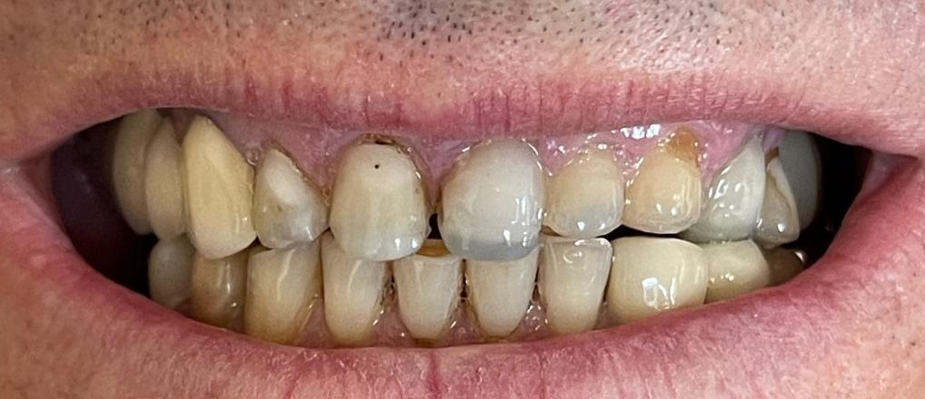 Before – dinți tratați pe canal înainte de aplicarea coroanelor dentare