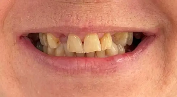 Before – restaurare complexă înainte de coroane și punți dentare, mușcătură incorectă