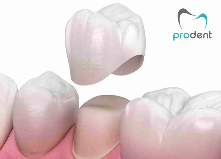 Coroană dentară Cluj – restaurări protetice ProDent
