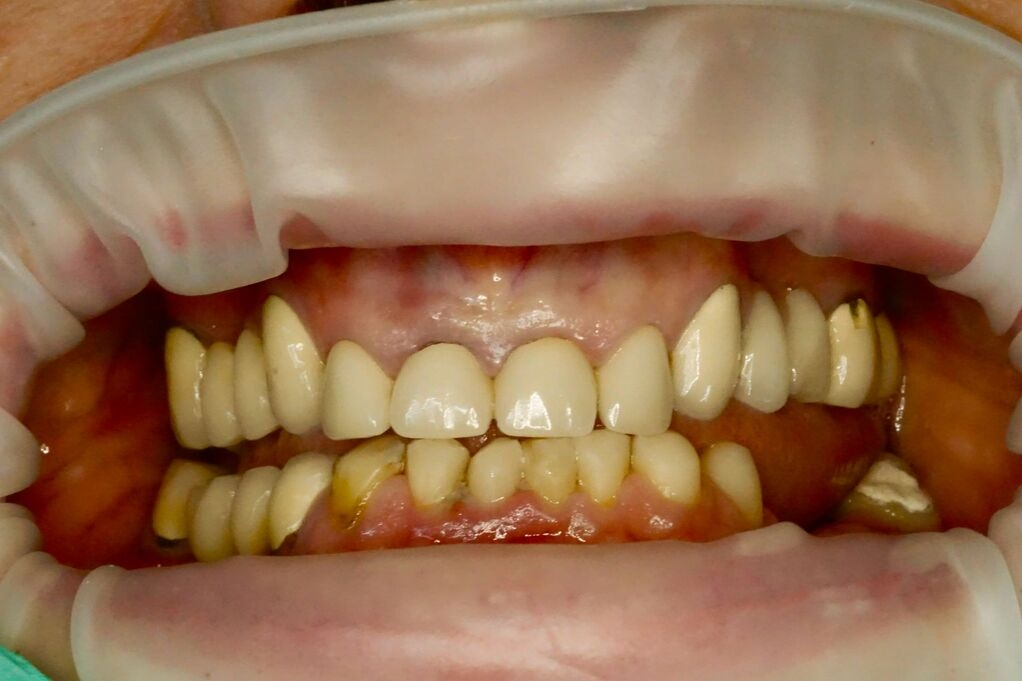 Before – lucrări dentare vechi înainte de înlocuire cu coroane dentare noi