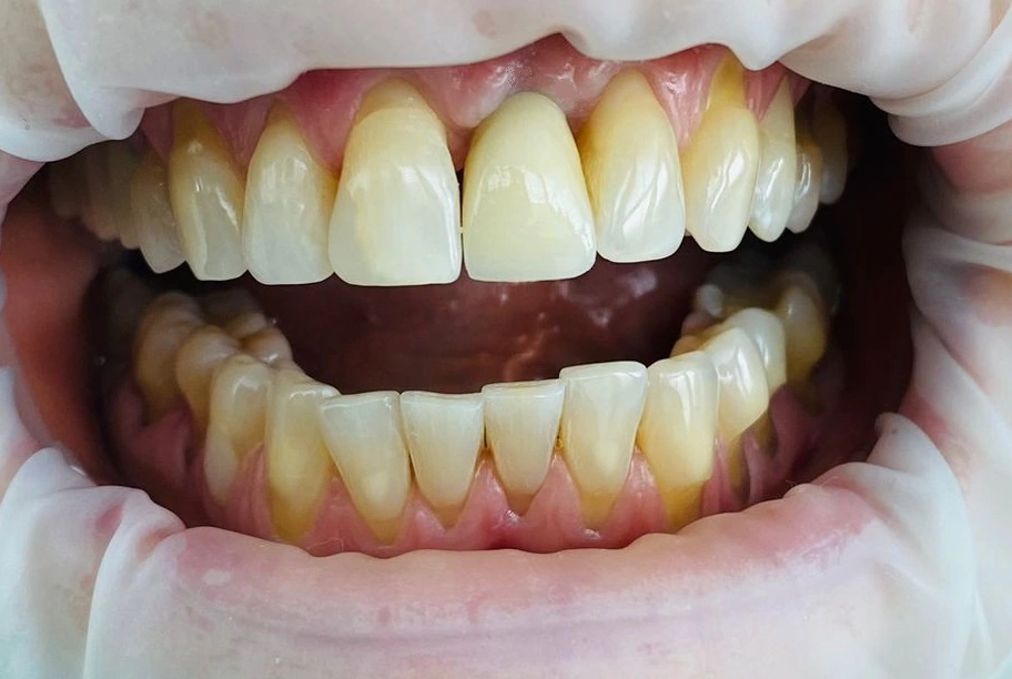After – coroană dentară fixă pe implant în zona frontală la ProDent Cluj-Napoca