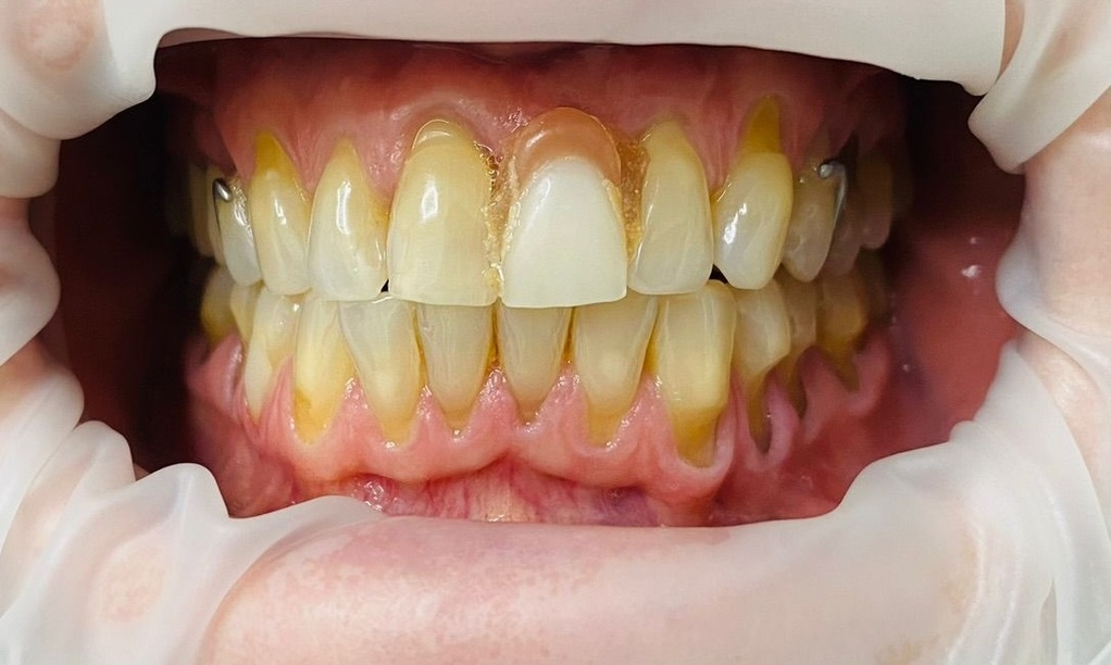 Before – proteză mobilizabilă înainte de coroană pe implant în zona frontală