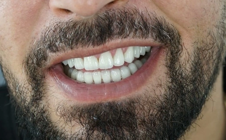 After – restaurare completă cu coroane, fațete și implanturi dentare realizată la ProDent Cluj-Napoca