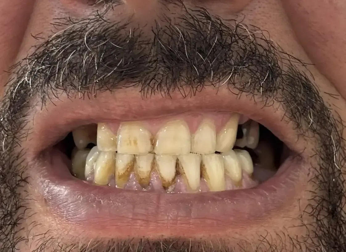 Before – restaurare completă înainte de coroane, fațete și implanturi dentare