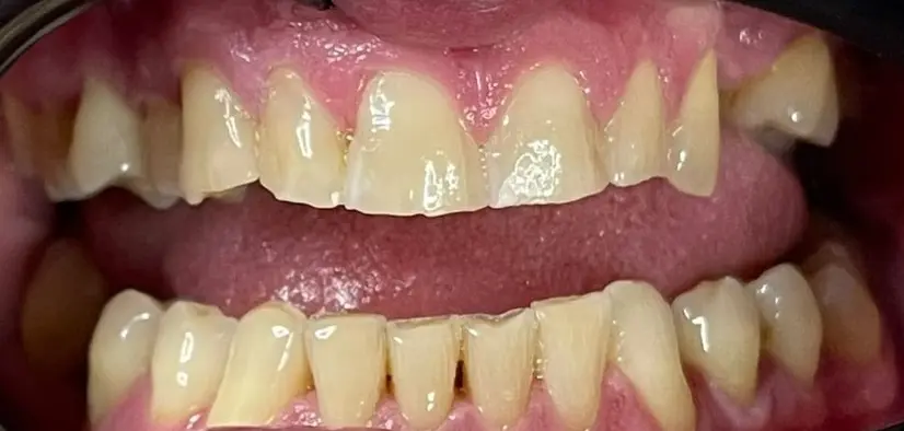 Before – restaurare complexă înainte de coroane și punți dentare, cu mușcătură incorectă