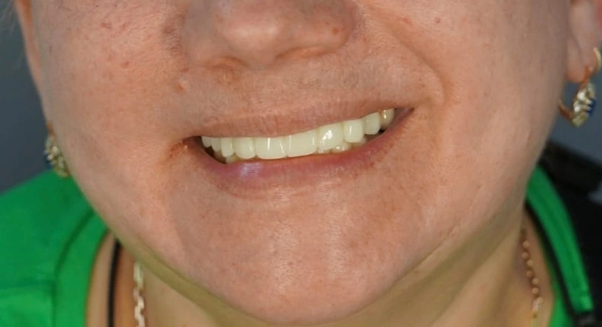 Both arches restored on implants after treatment at ProDent