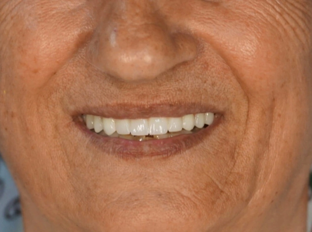 Upper-arch fixed restoration after treatment at ProDent