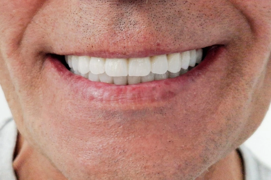 Full-arch implant rehabilitation after treatment at ProDent
