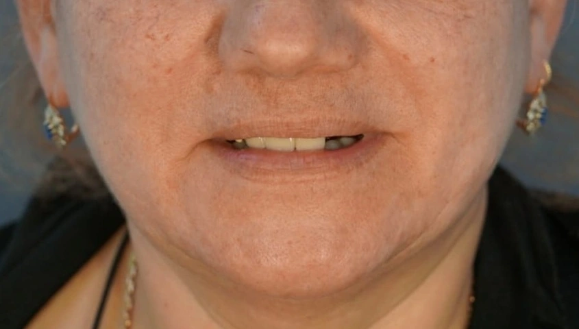 Both arches restored on implants before treatment at ProDent