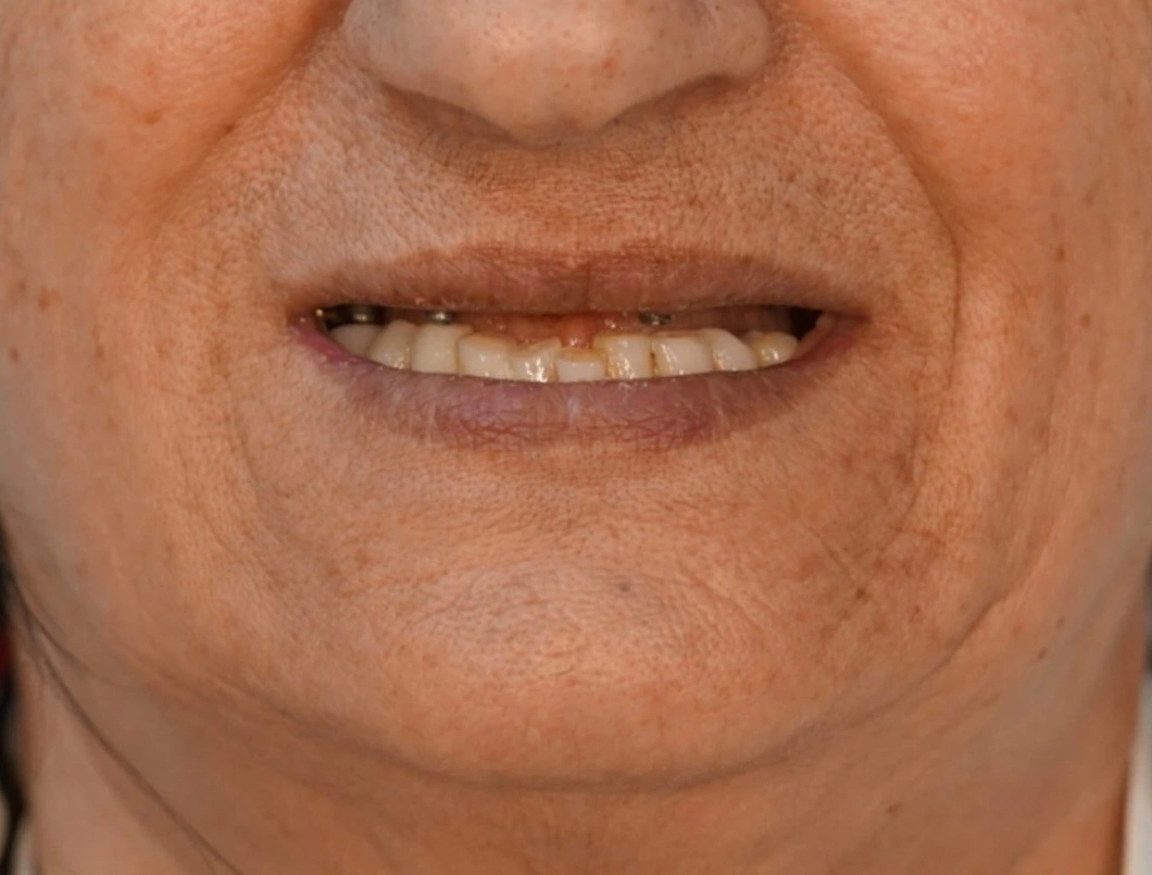 Upper-arch fixed restoration before treatment at ProDent