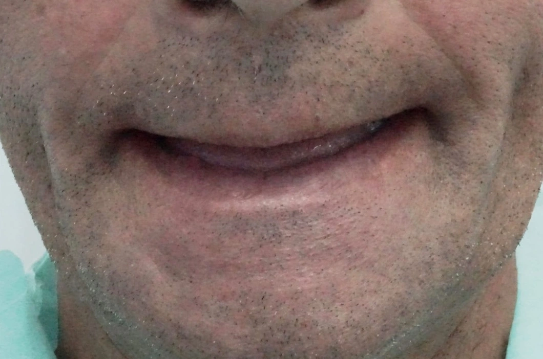 Full-arch implant rehabilitation before treatment at ProDent