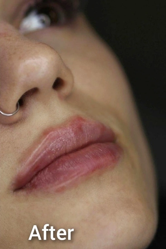 Rezultat după tratamentul cu acid hialuronic pentru buze la ProDent Cluj