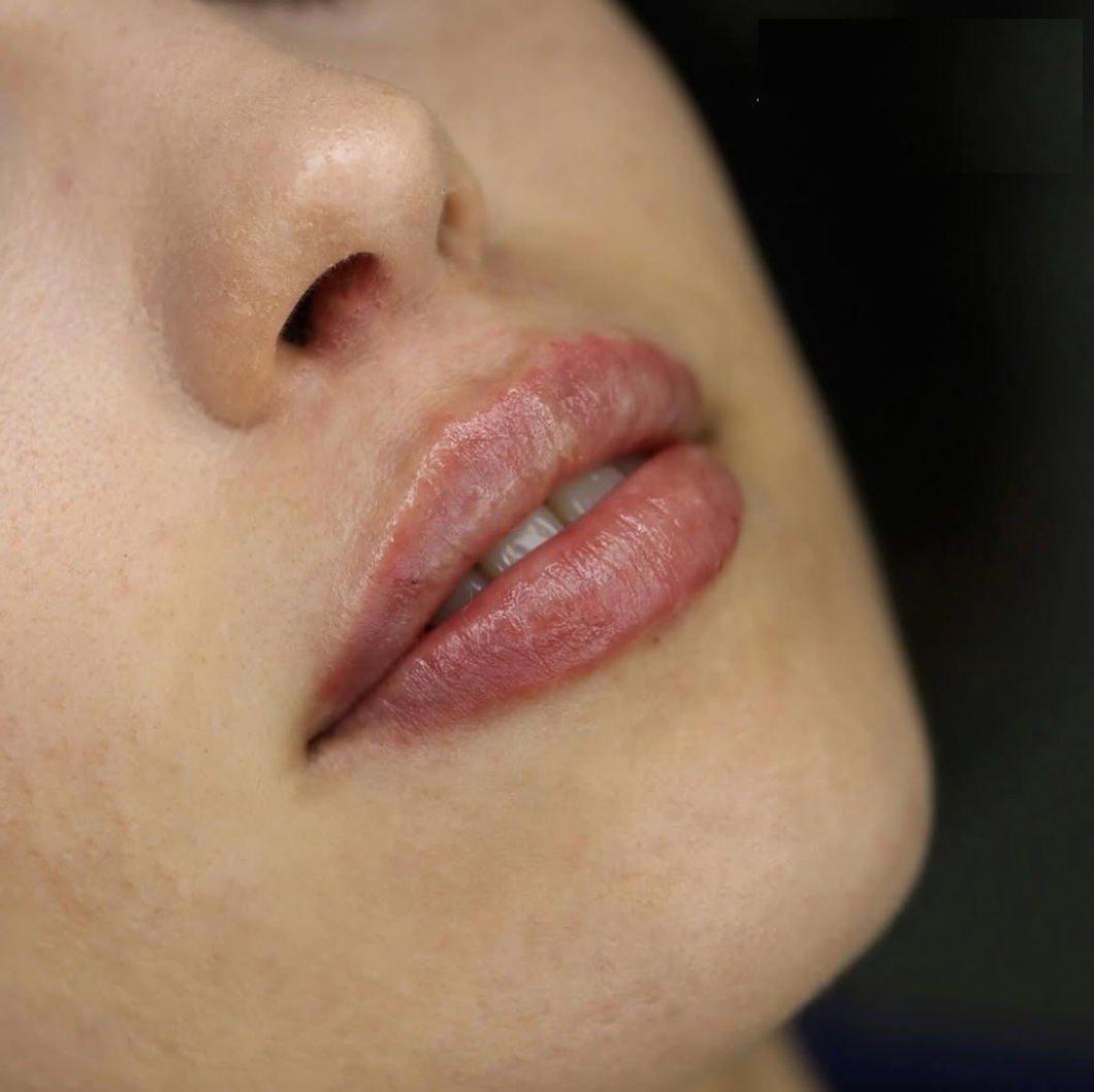 Estetică facială în Cluj la ProDent – acid buze, botox, rinocorecție