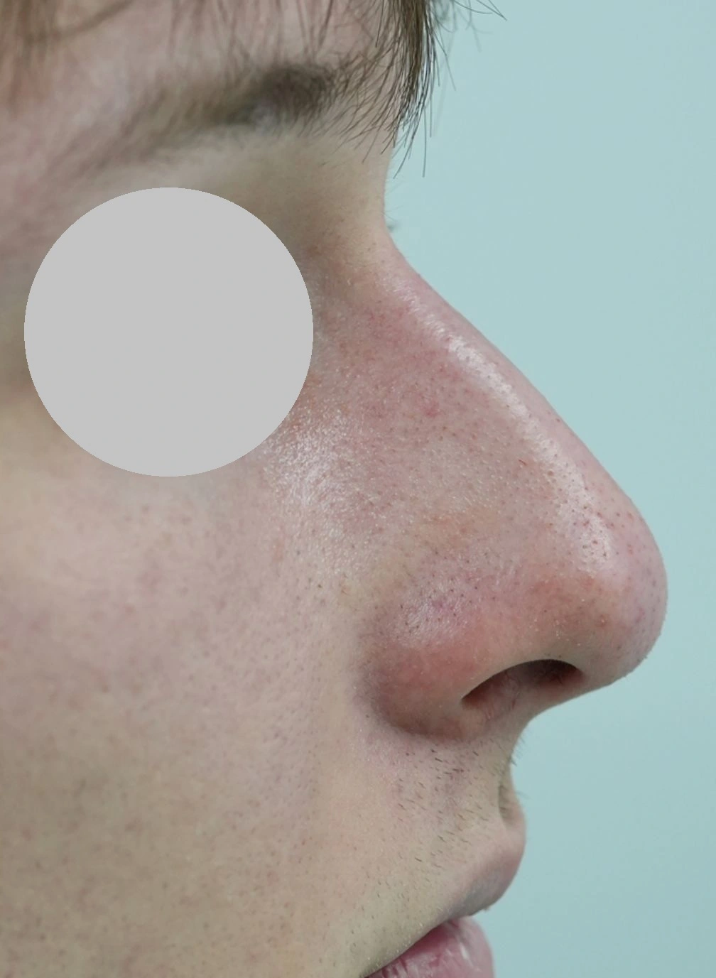 Rezultat după rinocorecție cu acid hialuronic la ProDent Cluj