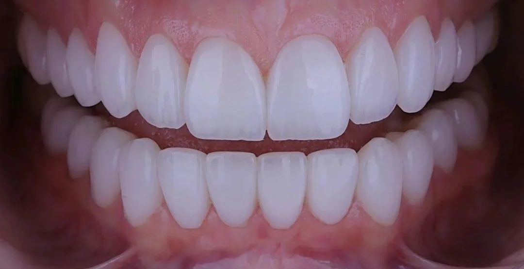 Improved tooth colour and shape after treatment at ProDent