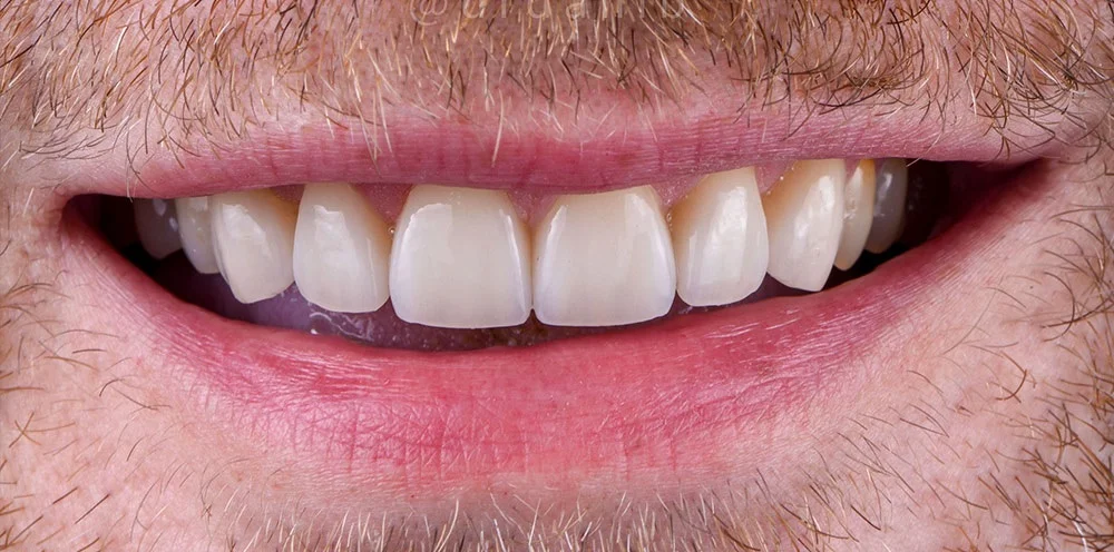 Restoring worn and chipped teeth after treatment at ProDent