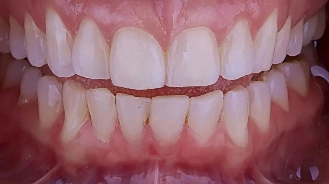 Improved tooth colour and shape before treatment at ProDent